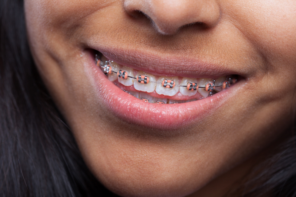 about our orthodontic office  Lawrenceville, GA